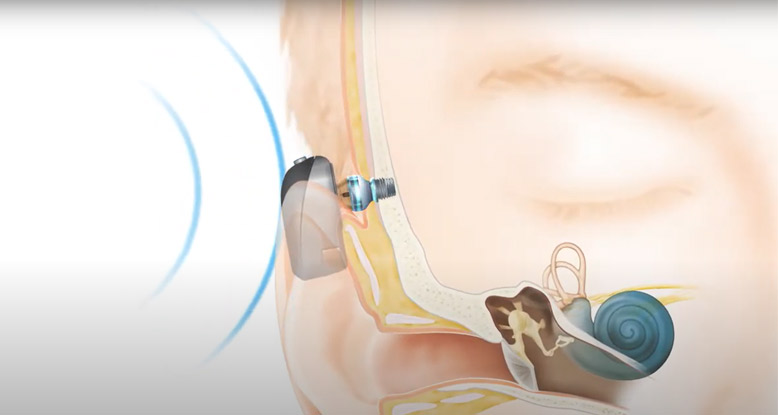 how_bone_conduction_implants_work.jpg