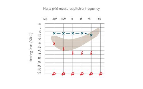 Exemple d’audiogramme