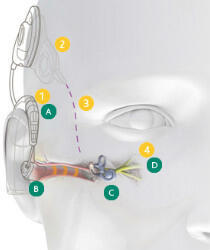 how_electro_acoustic_implants_works.jpg