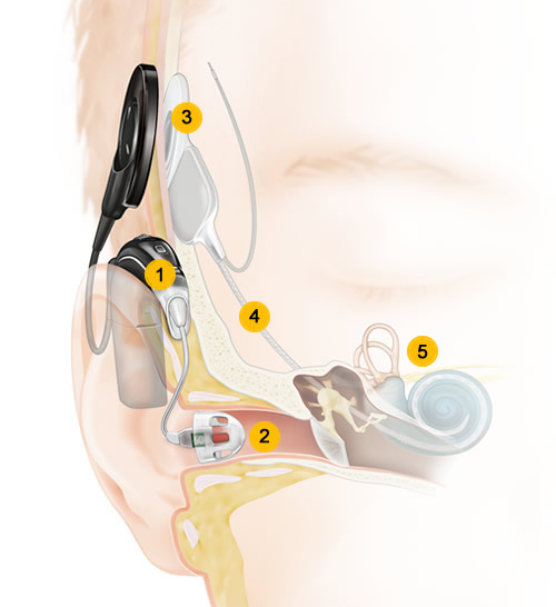 ID26-Cochlear-Nucleus-Hybrid-Implant-System-ProductsN7-hybrid_How-it_works-numbered2.jpg