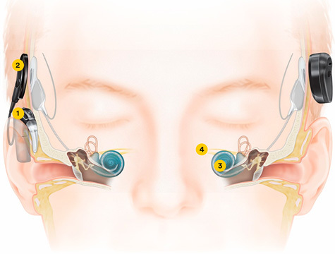 HearClearly_how-ci-works_N8.jpg