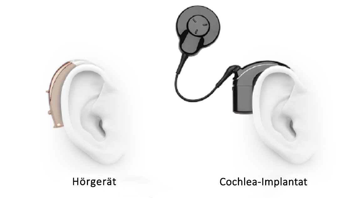 ci-hearing-aid-and-cochlear-implant_DE-DE.png