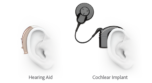 win-back-hearingaid-cochlearimplant.png
