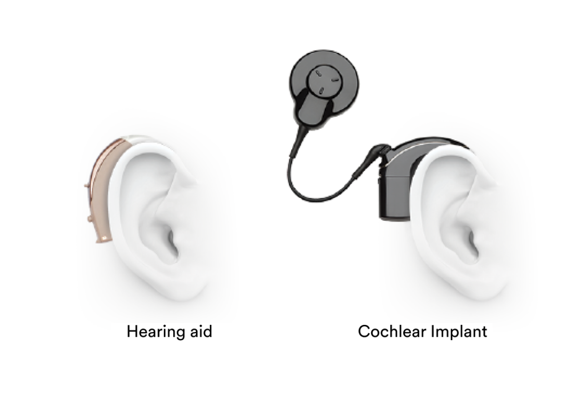 Hearing aid and cochlear implant image