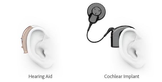hearingaid-cochlearimplant.png