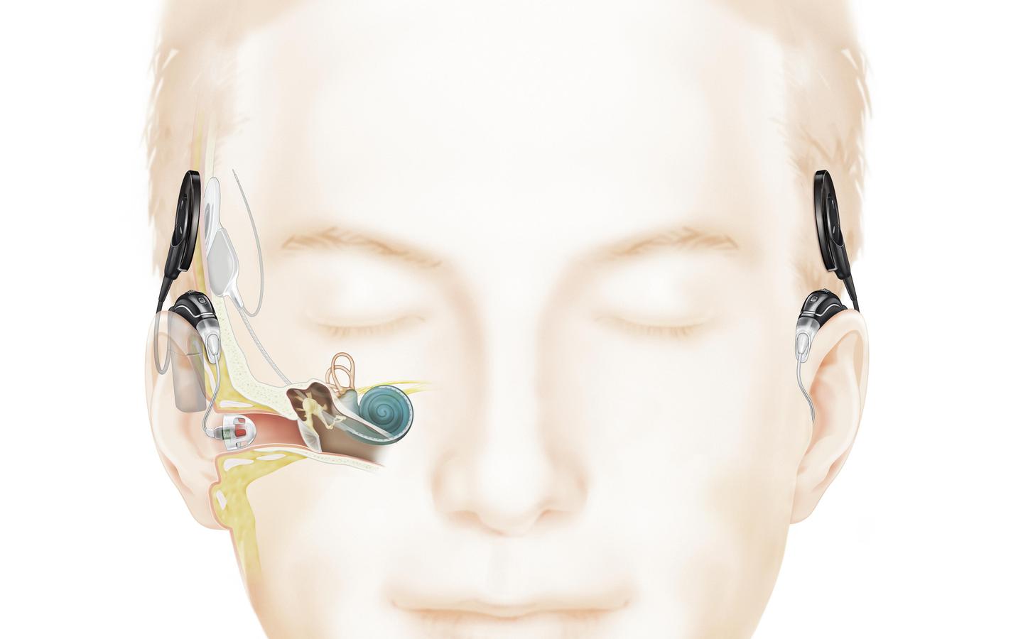 Cochlear Implant How It Works video thumb.jpg