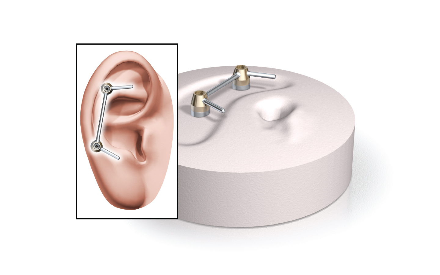 A Vistafix rendszer implantátumait és a fülprotézist bemutató ábra